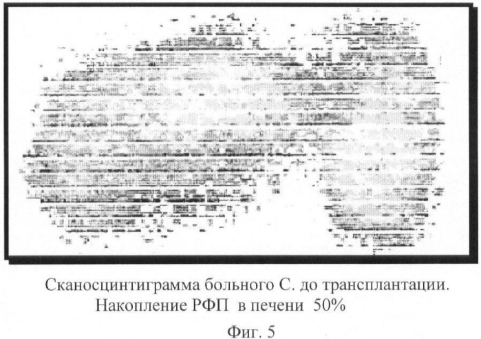 Биотрансплантат, способ лечения хронических заболеваний печени и способ лечения цирроза печени и портальной гипертензии (патент 2368384)