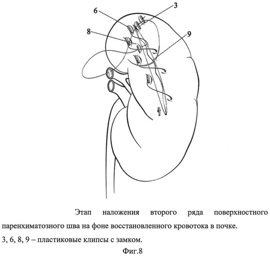 Способ ушивания раны почки при лапароскопическом органосохраняющем лечении рака почки в условиях тепловой ишемии (патент 2532897)