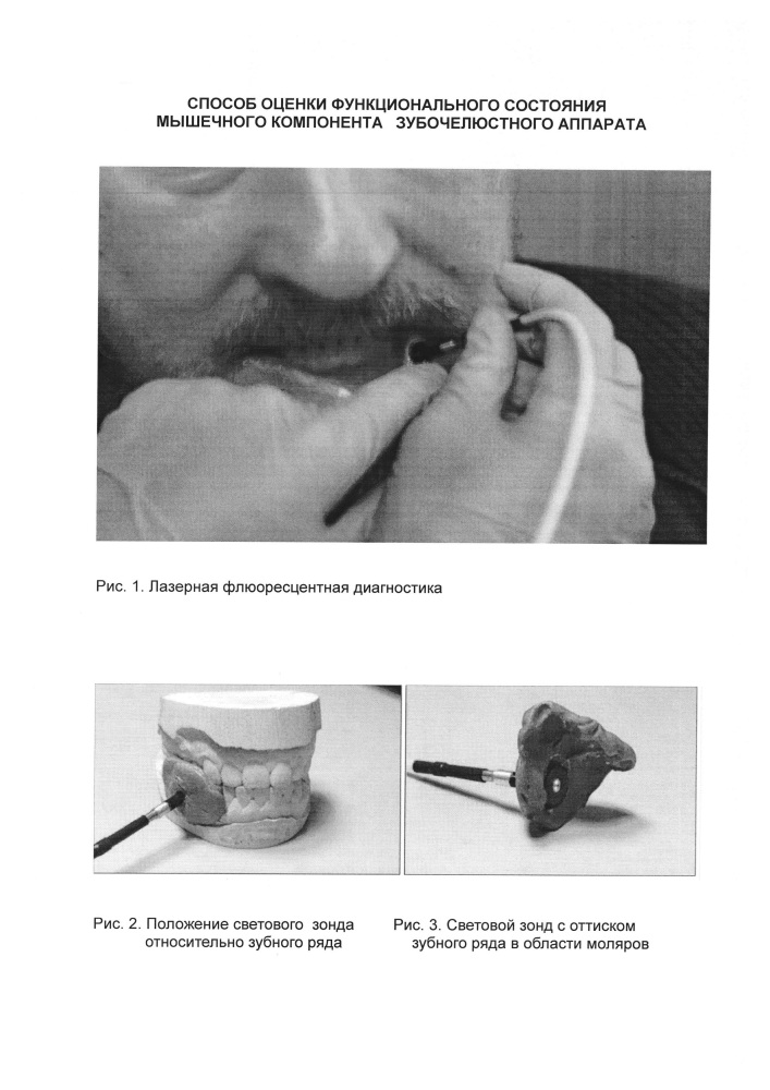 Способ оценки функционального состояния мышечного компонента зубочелюстного аппарата (патент 2628045)