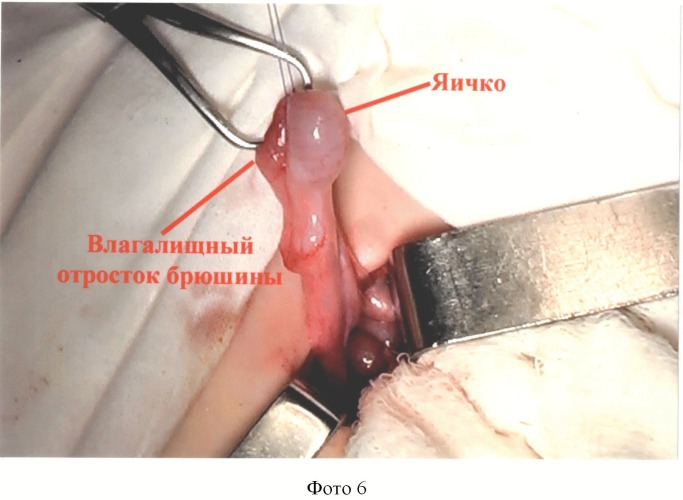 Способ низведения яичка при абдоминальной ретенции после пересечения тестикулярных сосудов (патент 2498780)