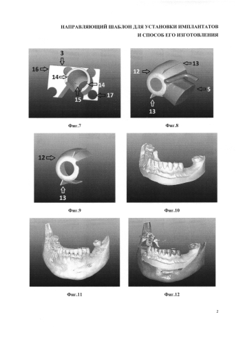 Направляющий шаблон для установки имплантатов и способ его изготовления (патент 2574575)