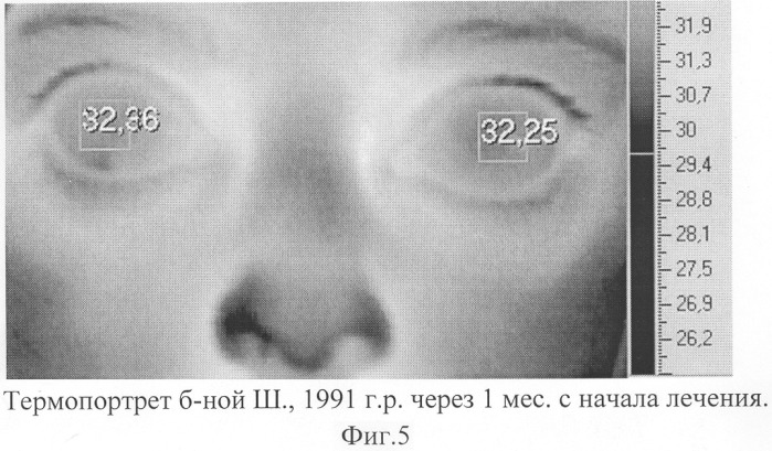 Способ диагностики ишемии зрительного нерва (патент 2299672)