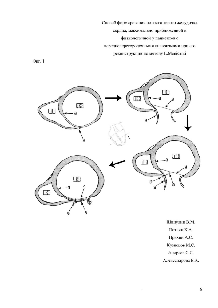 Способ формирования полости левого желудочка сердца, максимально приближенной к физиологичной, у пациентов с переднеперегородочными аневризмами при его реконструкции по методу l. menicanti (патент 2620049)