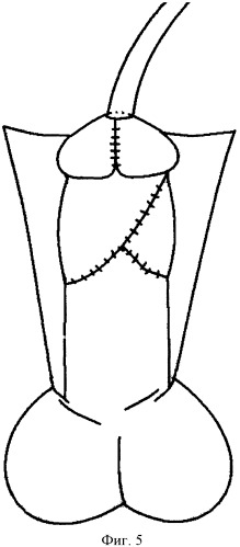 Способ хирургического лечения гипоспадии у мальчиков (патент 2435527)