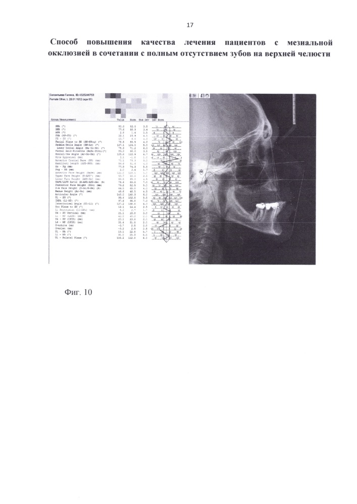 Способ повышения качества лечения пациентов с мезиальной окклюзией в сочетании с полным отсутствием зубов на верхней челюсти (патент 2658159)