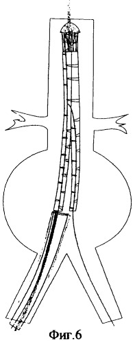 Эндоваскулярный бифуркационный имплантируемый протез (патент 2314778)