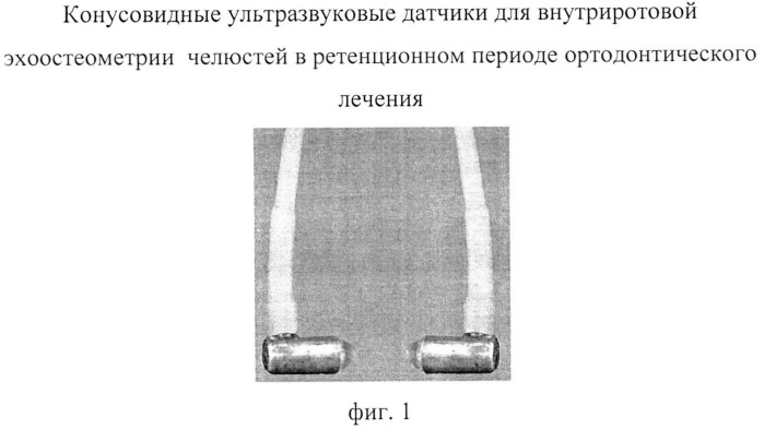 Способ эхоостеометрии челюстей в ретенционном периоде ортодонтического лечения (патент 2541038)