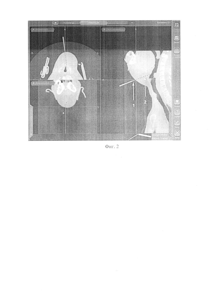Способ интраоперационной навигации в хирургическом лечении органов шеи (патент 2662644)