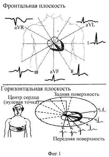 Устройство для регистрации результирующей экг на фронтальной и горизонтальной плоскостях (патент 2252695)