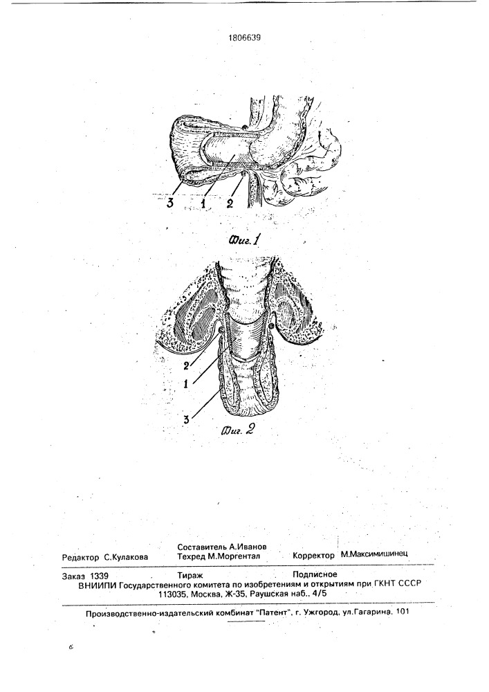 Способ хирургического лечения выпадения кишки из ануса (патент 1806639)