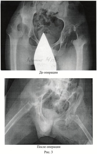 Способ лечения вывиха бедра у детей и подростков с вялыми параличами (патент 2458646)