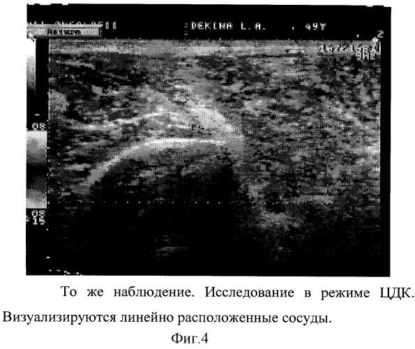 Способ ультразвуковой диагностики рецидивов мягкотканых сарком и фиброзных изменений (патент 2311129)