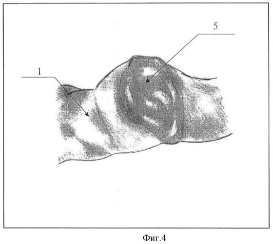 Способ герметизации межкишечного анастомоза (патент 2464942)