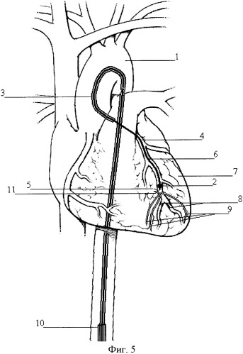 Коронарный катетер (патент 2355435)