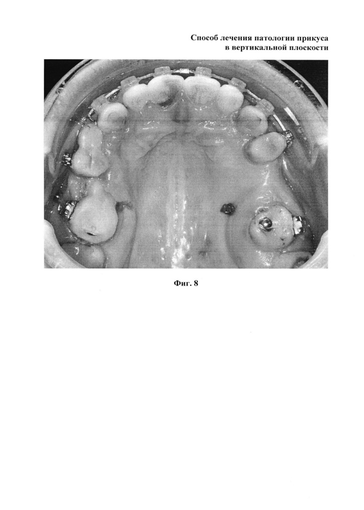 Способ лечения патологии прикуса в вертикальной плоскости (патент 2617181)