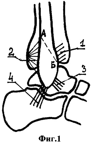 Наружный трансоссальный доступ к голеностопному суставу и таранной кости (патент 2422107)