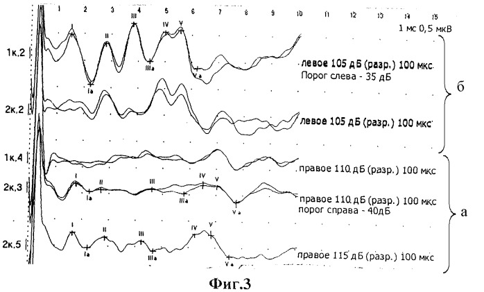 Способ диагностики ретрокохлеарных и центральных слуховых нарушений (патент 2402266)
