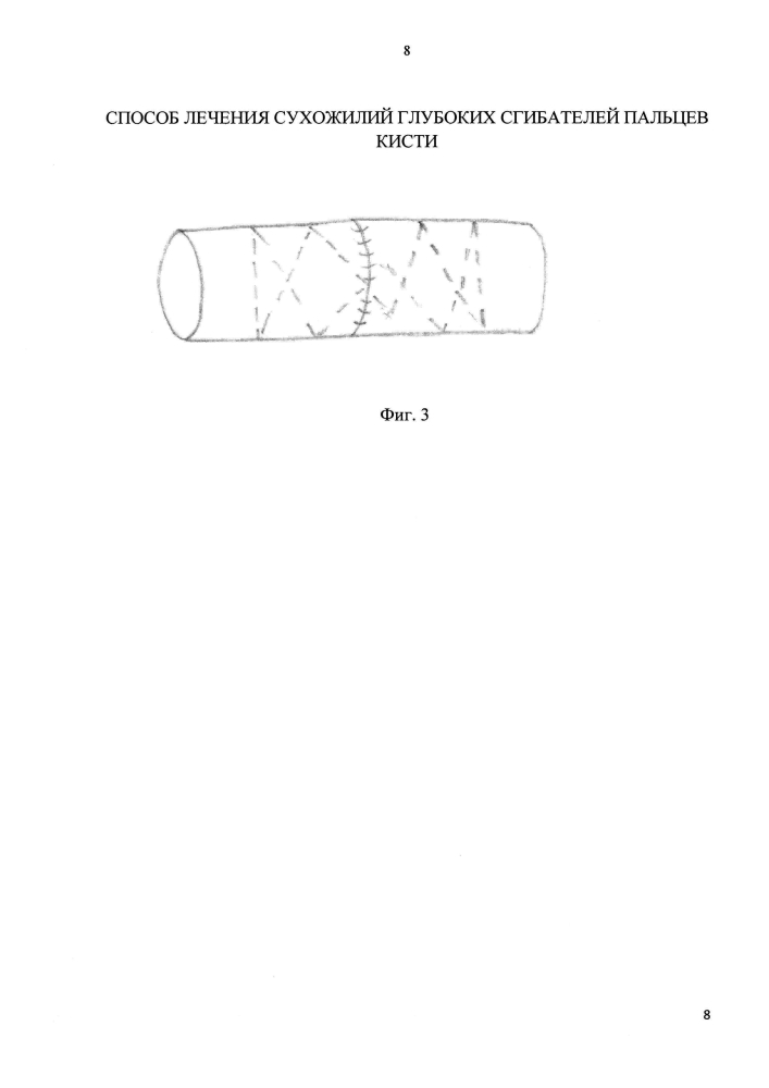 Способ лечения повреждений сухожилий глубоких сгибателей пальцев кисти (патент 2602796)