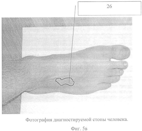 Способ оценки эффективности ортопедической коррекции стопы (патент 2357705)