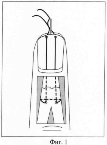 Способ лечения повреждений сухожилия разгибателя пальца кисти (патент 2334479)