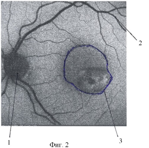 Способ прогнозирования течения возрастной макулярной дегенерации (патент 2386387)