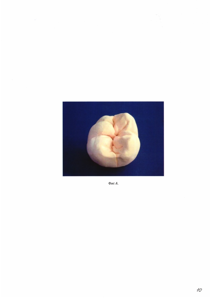 Способ восстановления коронковой части многокорневых зубов на основе модульных технологий (патент 2618950)