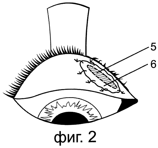 Способ лечения рубцового заворота века в сочетании с трихиазом (патент 2564962)