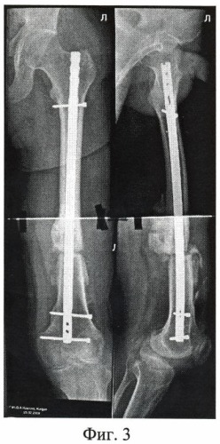 Способ лечения больных с застарелыми, неправильно сросшимися переломами бедренной кости (патент 2445032)