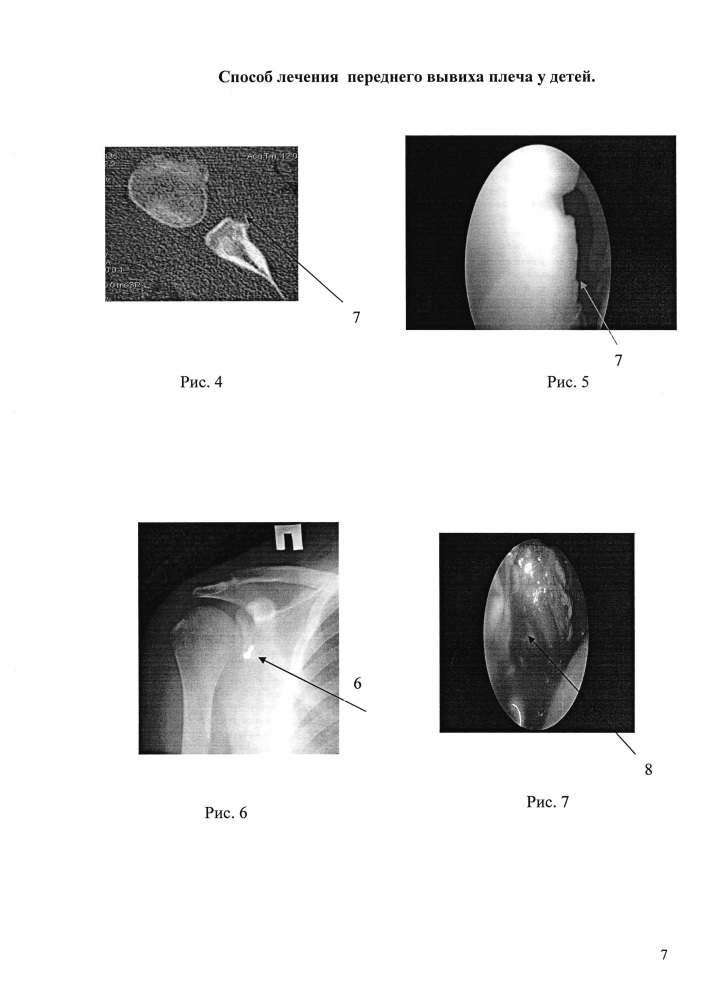 Способ лечения переднего вывиха плеча у детей (патент 2663076)