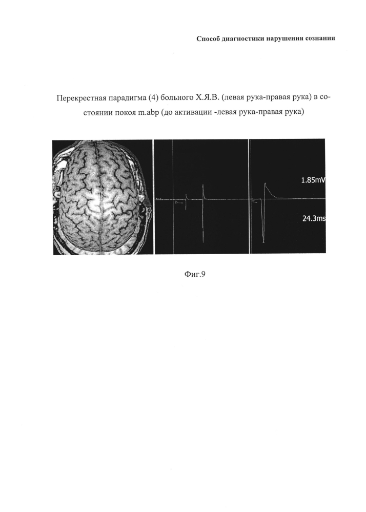 Способ диагностики нарушения сознания (патент 2596049)