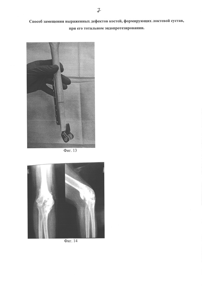 Способ замещения выраженных дефектов костей, формирующих локтевой сустав, при его тотальном эндопротезировании (патент 2662899)