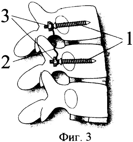 Устройство для внутренней транспедикулярной фиксации позвоночника (патент 2326617)
