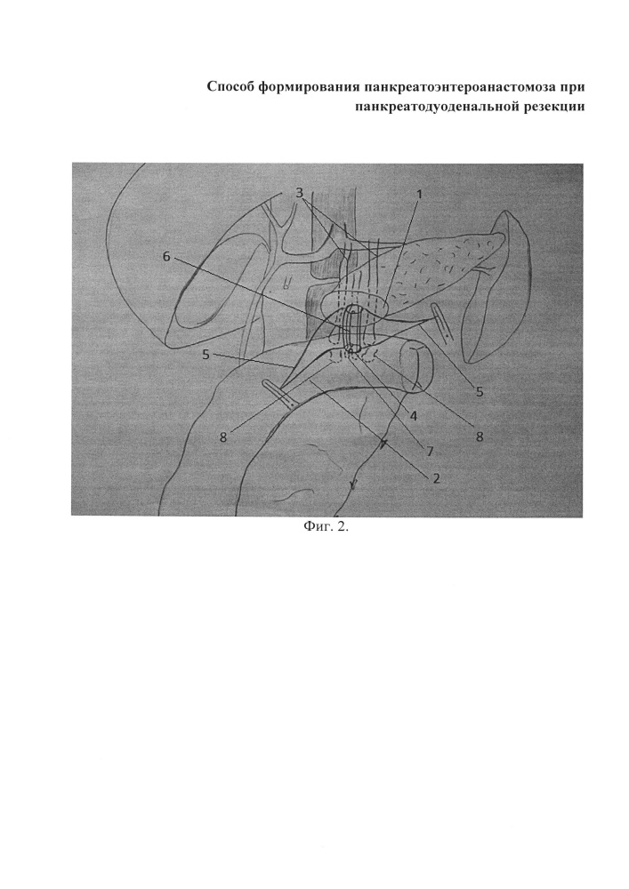 Способ формирования панкреатоэнтероанастомоза при панкреатодуоденальной резекции (патент 2655503)