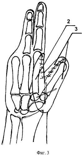 Способ перемещения культи пястной кости при последствиях глубокого ожога кисти (патент 2391930)