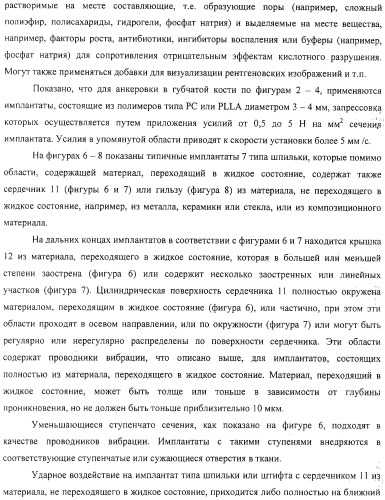 Имплантаты для создания соединений с тканями, в частности со скелетом, а также устройство и способ имплантации (патент 2314768)