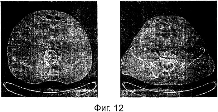 Избирательное выявление костных метастазов при светлоклеточной почечно-клеточной карциноме (патент 2536290)