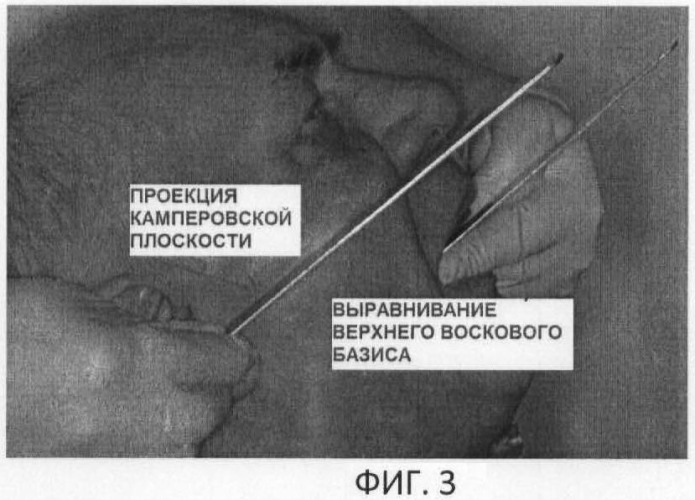 Верхняя плоскость. Протетическая плоскость. Протеьисеская плоаеость. Протетическая плоскость в стоматологии. Протетическая и Камперовская плоскость.