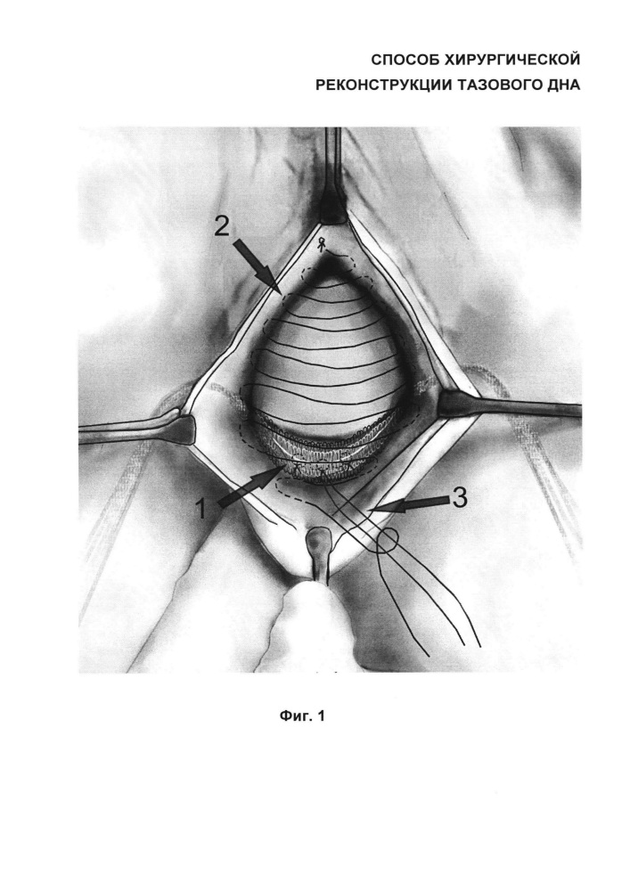 Способ хирургической реконструкции тазового дна (патент 2661042)