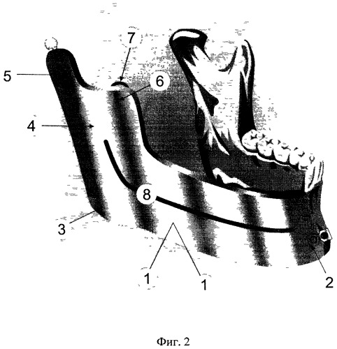 Имплантат-эндопротез для замещения объемного костного дефекта нижней челюсти (патент 2491899)