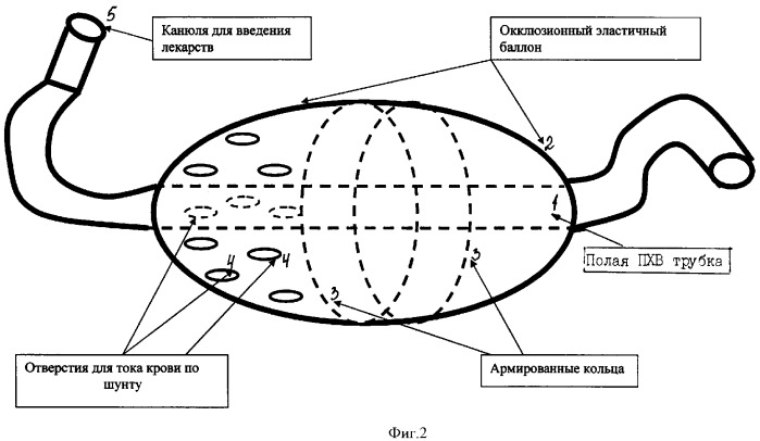 Интраартериальный каротидный шунт (патент 2375083)