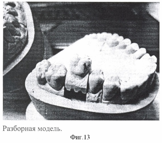 Способ воспроизведения зарегистрированных окклюзионных положений на компьютерных трехмерных моделях зубных рядов и ориентации компьютерных трехмерных моделей в пространстве (патент 2401083)