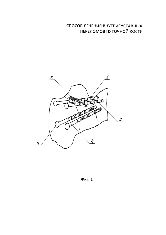 Способ лечения внутрисуставных переломов пяточной кости (патент 2630870)