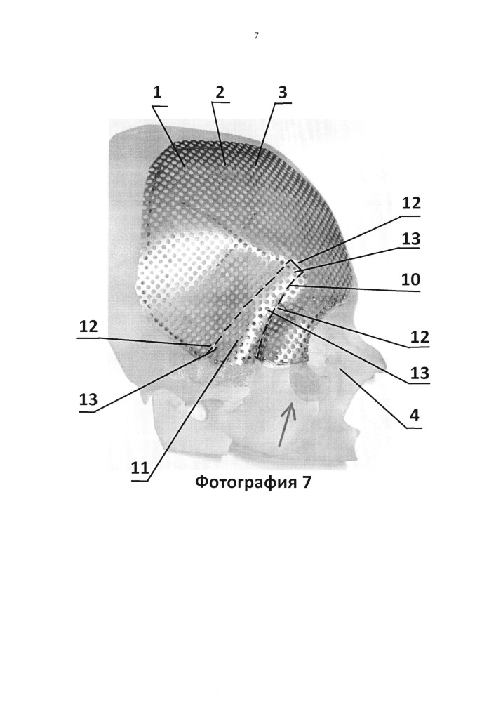 Имплантат для протезирования костей черепа и способ изготовления имплантата для протезирования костей черепа (патент 2638894)