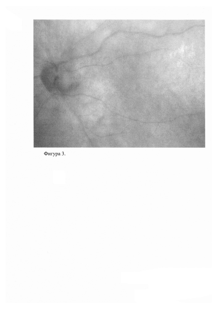 Способ определения посттравматических изменений глазного дна и уточнения тяжести поражения (патент 2624374)
