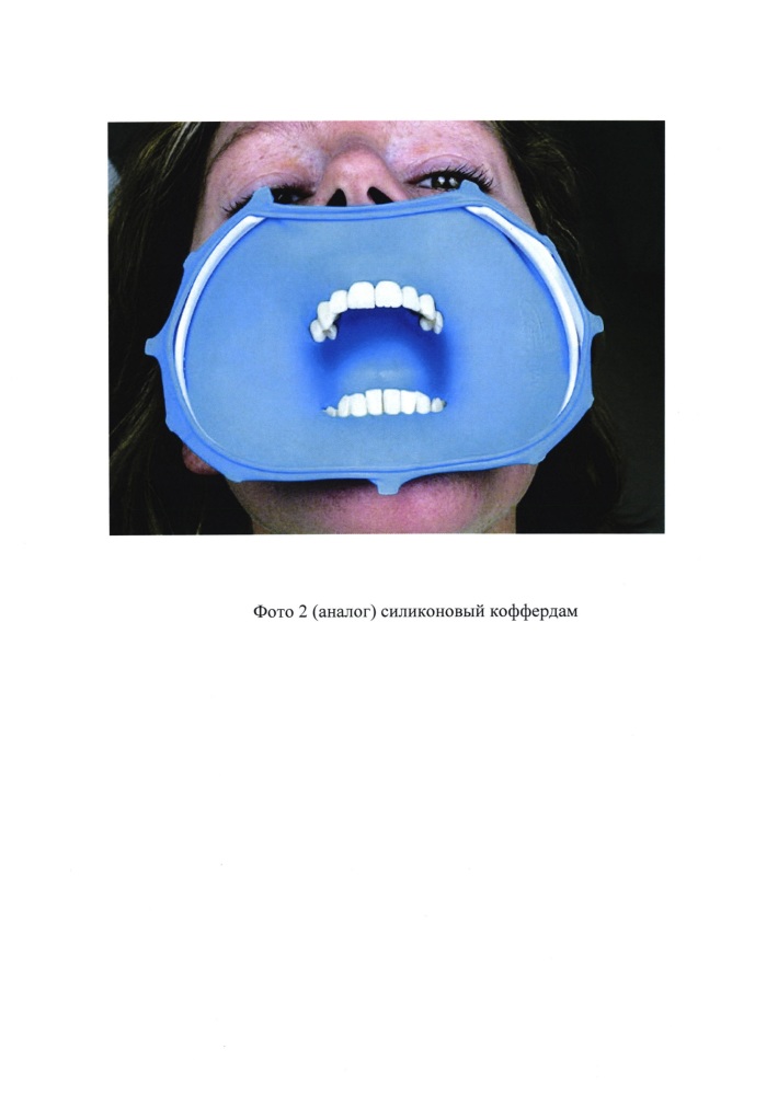 Стоппер для защиты органов полости рта от распространения коротковолнового ультрафиолетового излучения (патент 2647228)