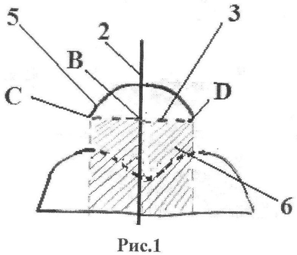 Способ ультразвукового определения величины латеральной дислокации надколенника (патент 2533837)