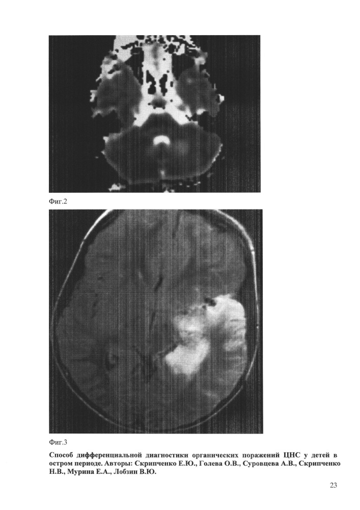Способ дифференциальной диагностики органических поражений цнс у детей в остром периоде (патент 2648215)
