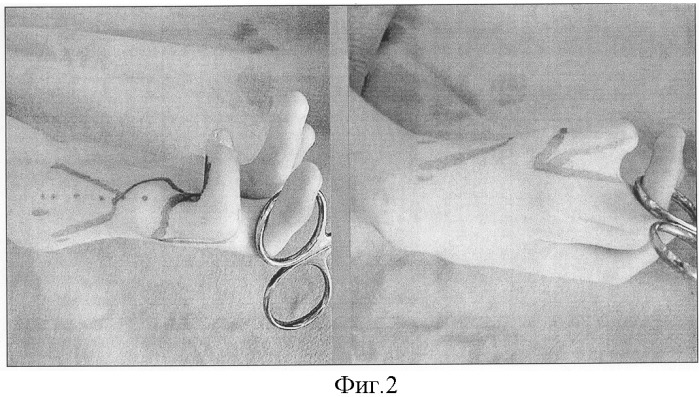 Способ восстановления функции кисти при сочетании врожденной гипоплазии и аплазии первого пальца кисти с лучевой косорукостью (патент 2300333)