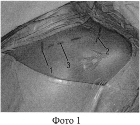 Миниинвазивный хирургический доступ при остеосинтезе переломов диафиза ключицы (патент 2559144)