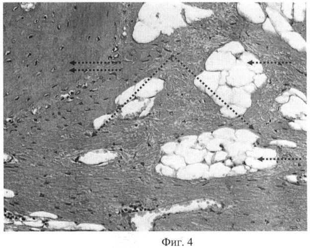 Способ устранения костных дефектов с восстановлением в них костной ткани (патент 2449755)